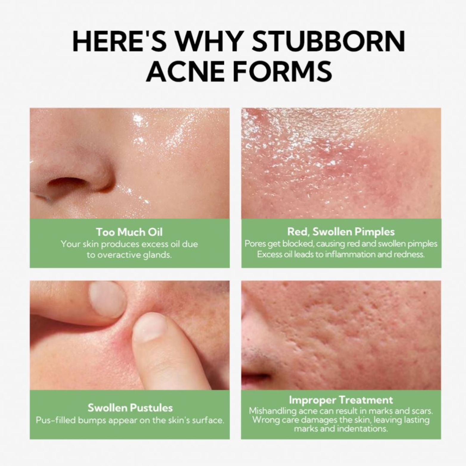 Lomelia Anti Acnes Face Serum